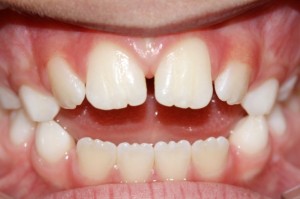 Anterior Open Bite -  A result of thumb sucking and the tongue resting between the teeth.