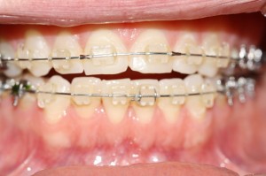 Anterior Open Bite - A result of tongue thrust swallow and the tongue resting between the teeth.